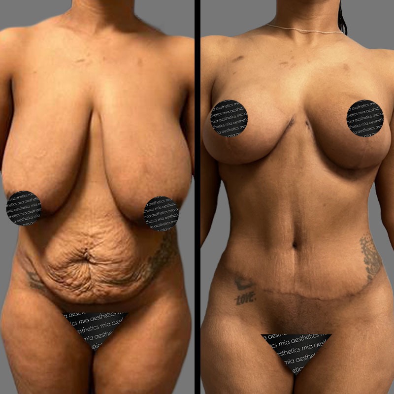 Dr. Mehio • Breast Procedures • image 5