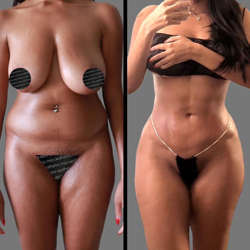 Dr. Mehio • Lipo 360 • image 2