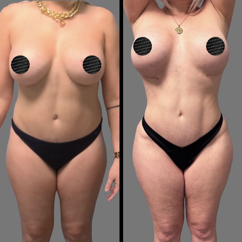 Dr. Mehio • Lipo 360 • image 3