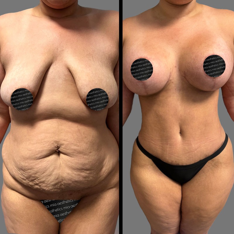 Dr. Mehio • Mommy Makeover • image 5
