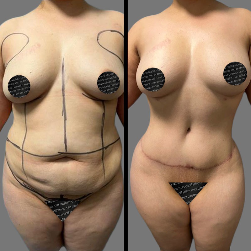 Dr. Mehio • Tummy Tuck • image 1
