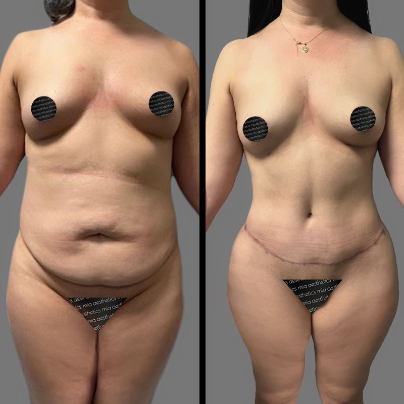 Dr. Mehio • Tummy Tuck • image 2