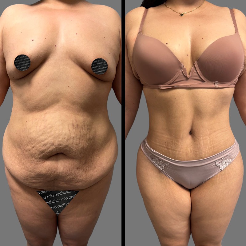 Dr. Mehio • Tummy Tuck • image 3