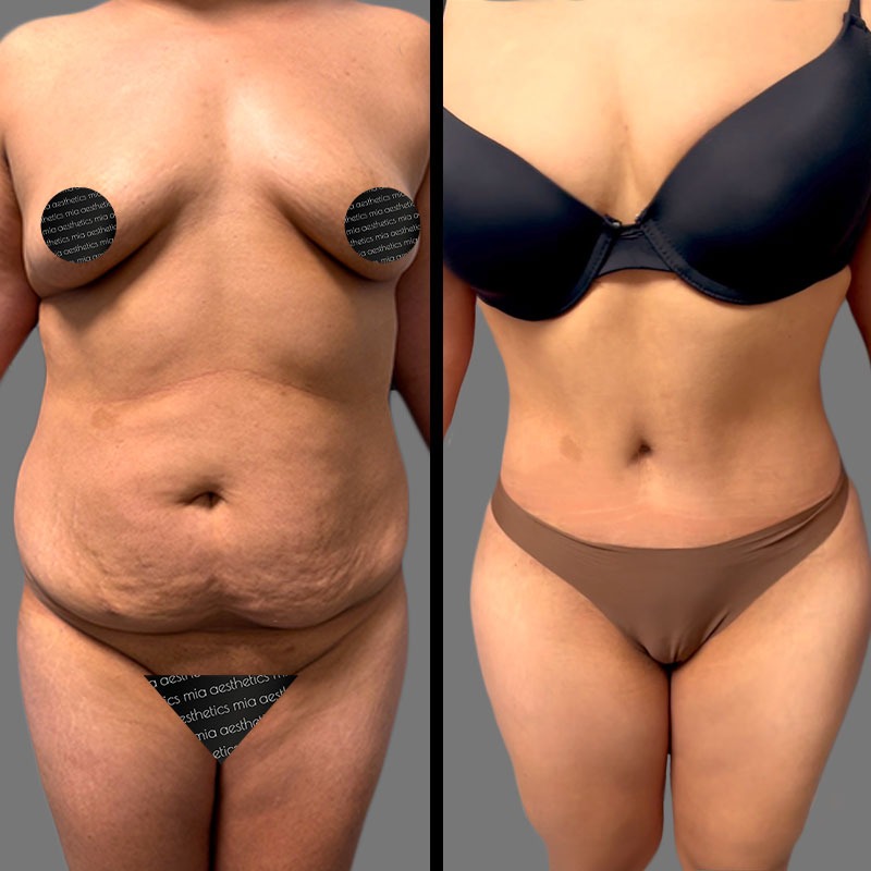 Dr. Mehio • Tummy Tuck • image 5