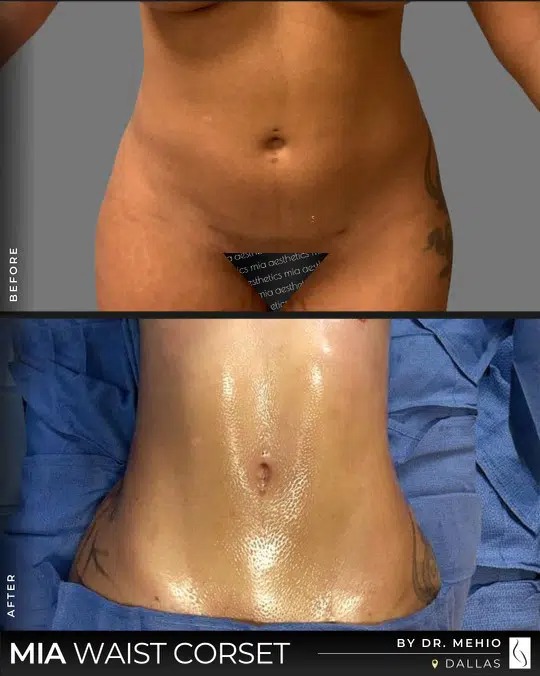 Dr. Mehio • Mia Waist Corset™ • image 1