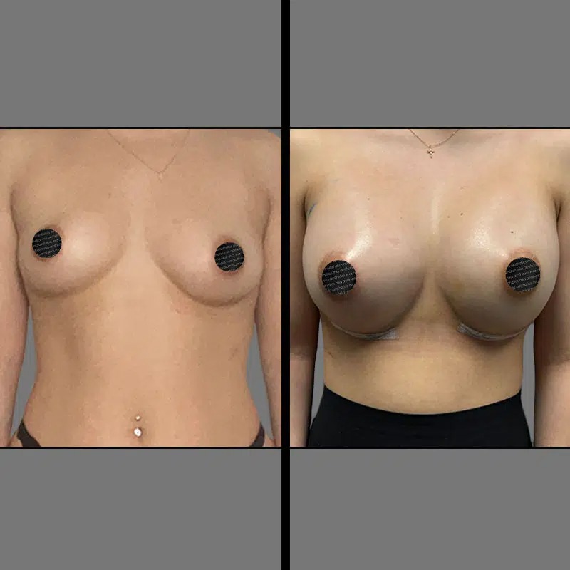 Dr. Morse • Breast Procedures • image 1