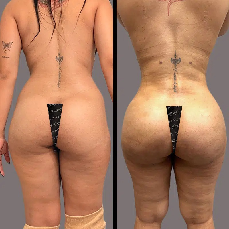 Dr. Morse • Brazilian Butt Lift (BBL) • image 3