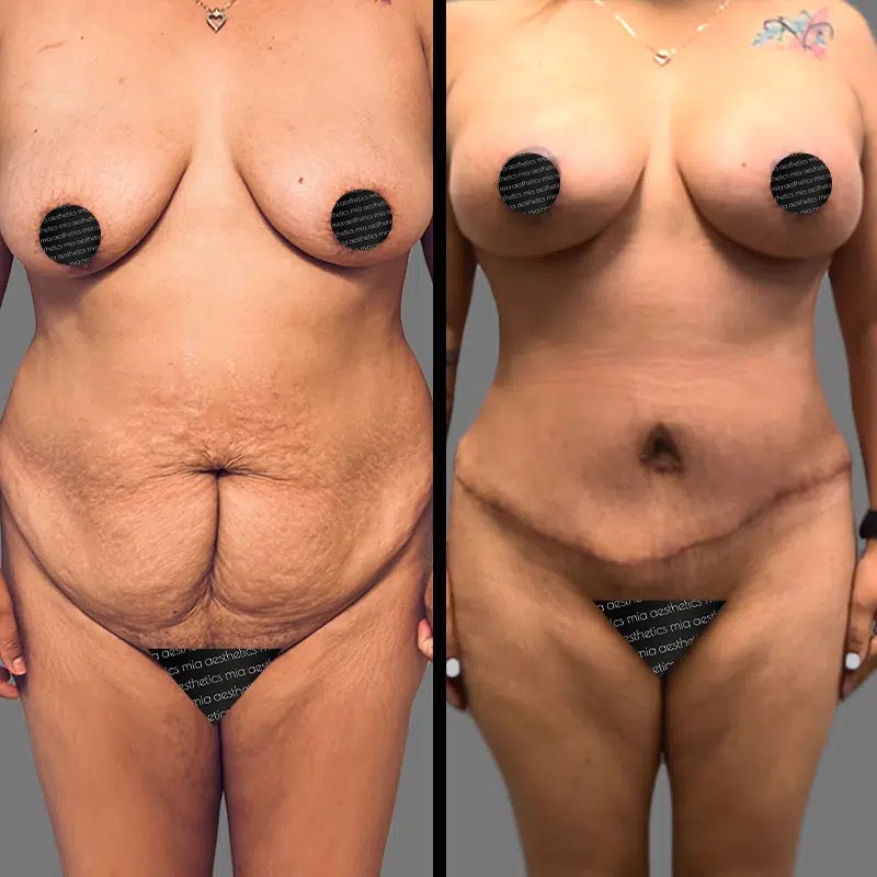 Dr. Morse • Mommy Makeover • image 1