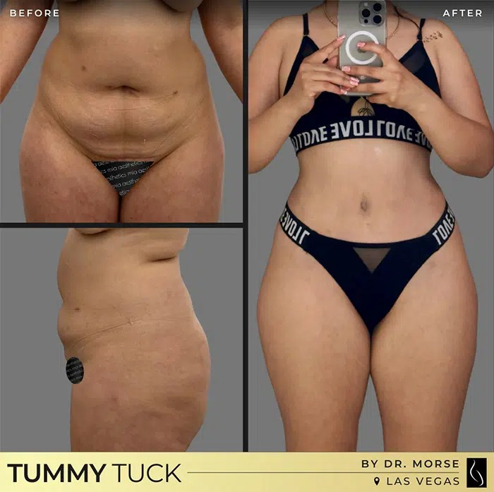 Dr. Morse • Tummy Tuck • image 1