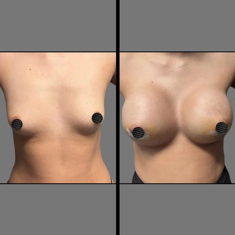 Dr. Orlando • Breast Procedures • image 5