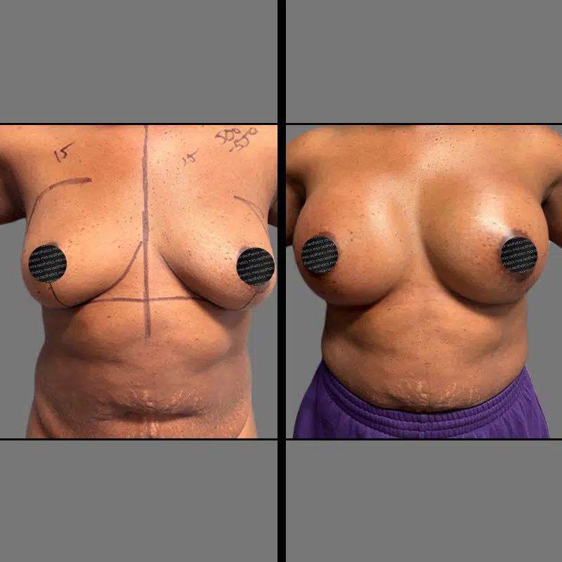 Dr. Orlando • Breast Procedures • image 4
