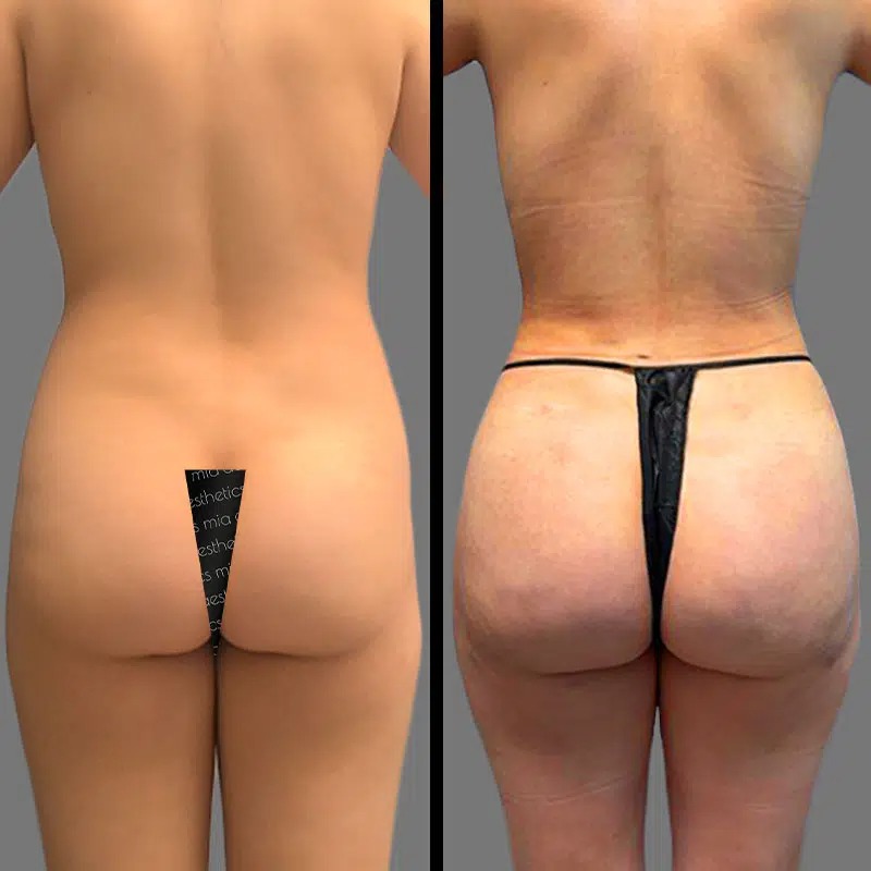 Dr. Orlando • Brazilian Butt Lift (BBL) • image 2