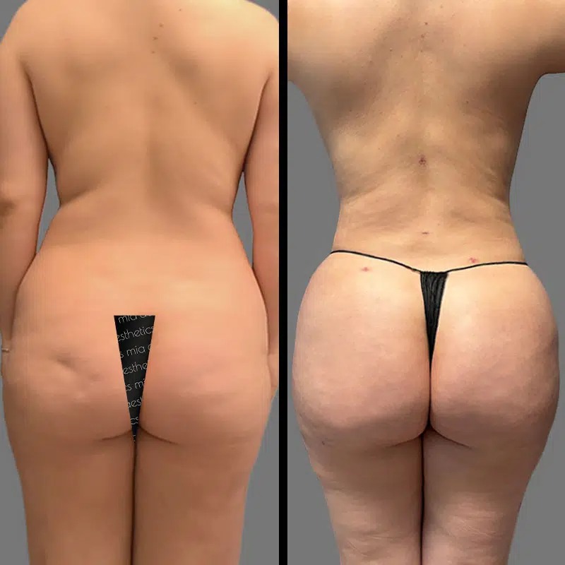 Dr. Orlando • Brazilian Butt Lift (BBL) • image 3