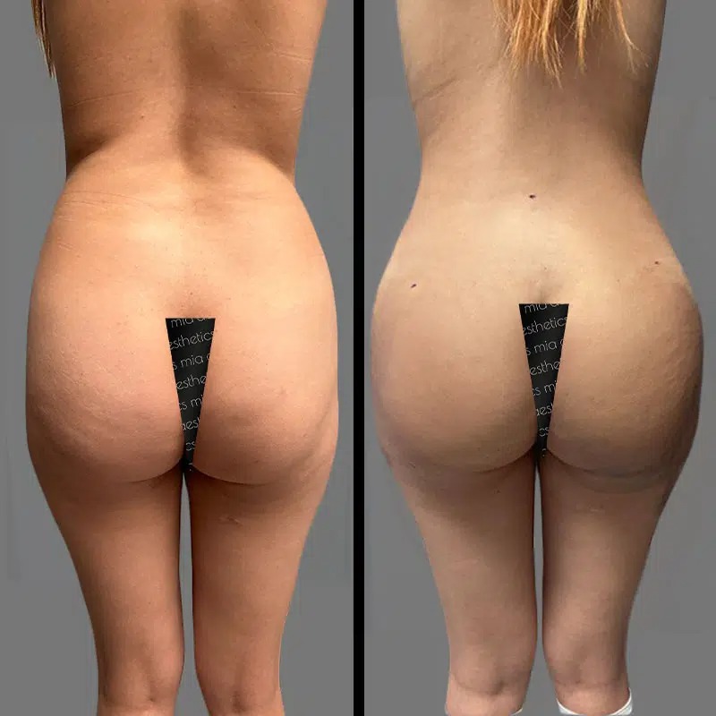 Dr. Orlando • Brazilian Butt Lift (BBL) • image 4