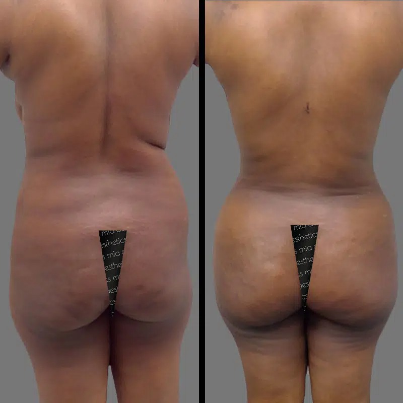 Dr. Orlando • Brazilian Butt Lift (BBL) • image 5