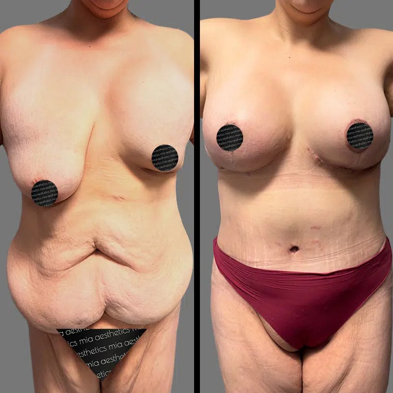 Dr. Orlando • Mommy Makeover • image 2