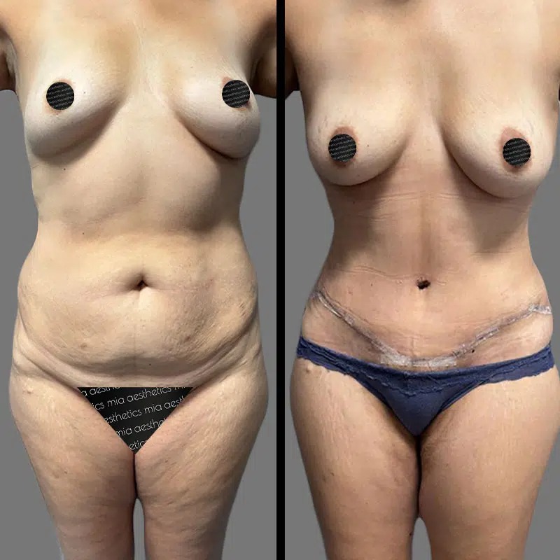 Dr. Orlando • Tummy Tuck • image 1