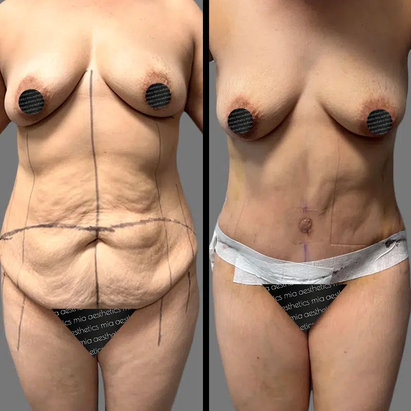 Dr. Orlando • Tummy Tuck • image 3