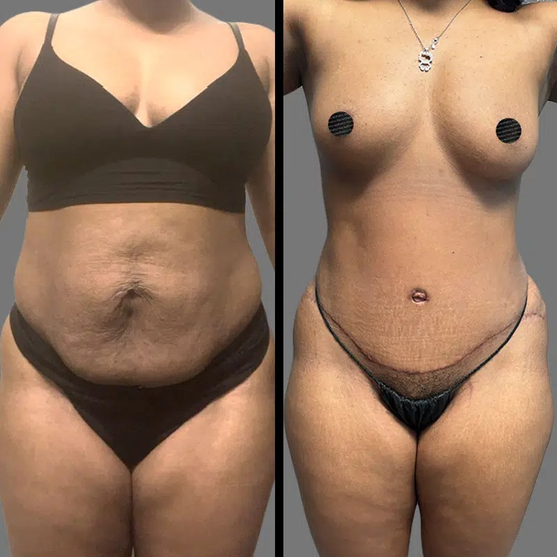 Dr. Orlando • Tummy Tuck • image 4