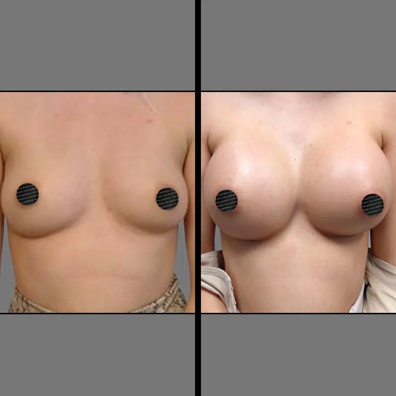 Dr. Patino • Breast Procedures • image 1