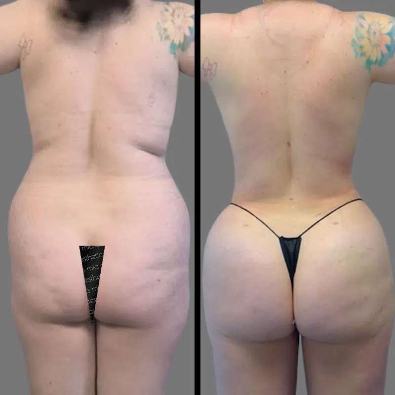 Dr. Patino • Brazilian Butt Lift (BBL) • image 1