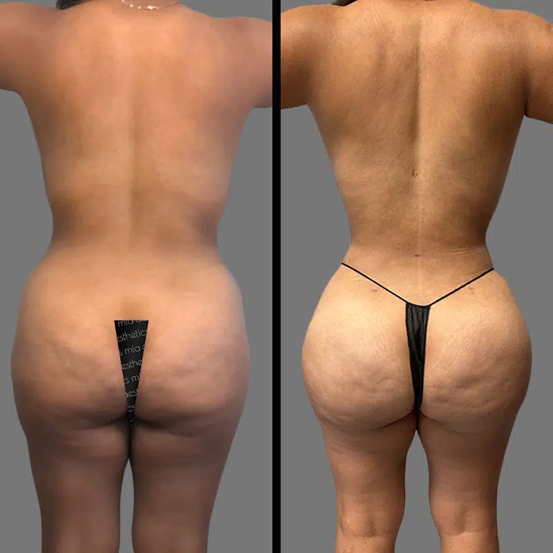 Dr. Patino • Brazilian Butt Lift (BBL) • image 2