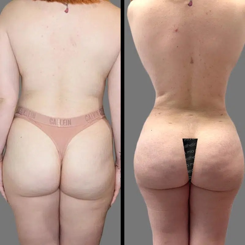 Dr. Patino • Brazilian Butt Lift (BBL) • image 5