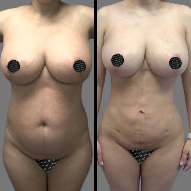 Dr. Patino • Lipo 360 • image 2