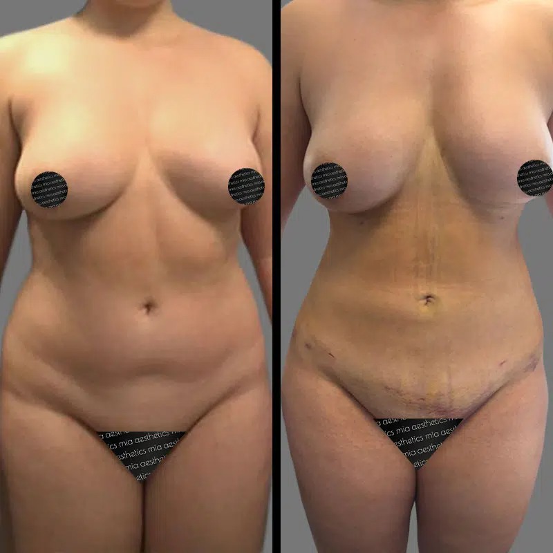 Dr. Patino • Lipo 360 • image 5