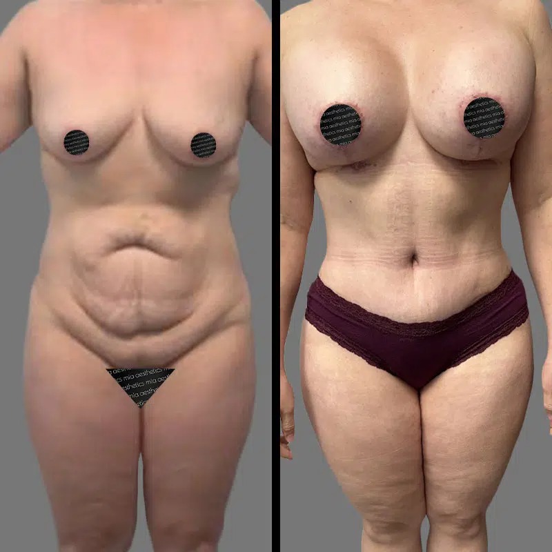 Dr. Patino • Mommy Makeover • image 1