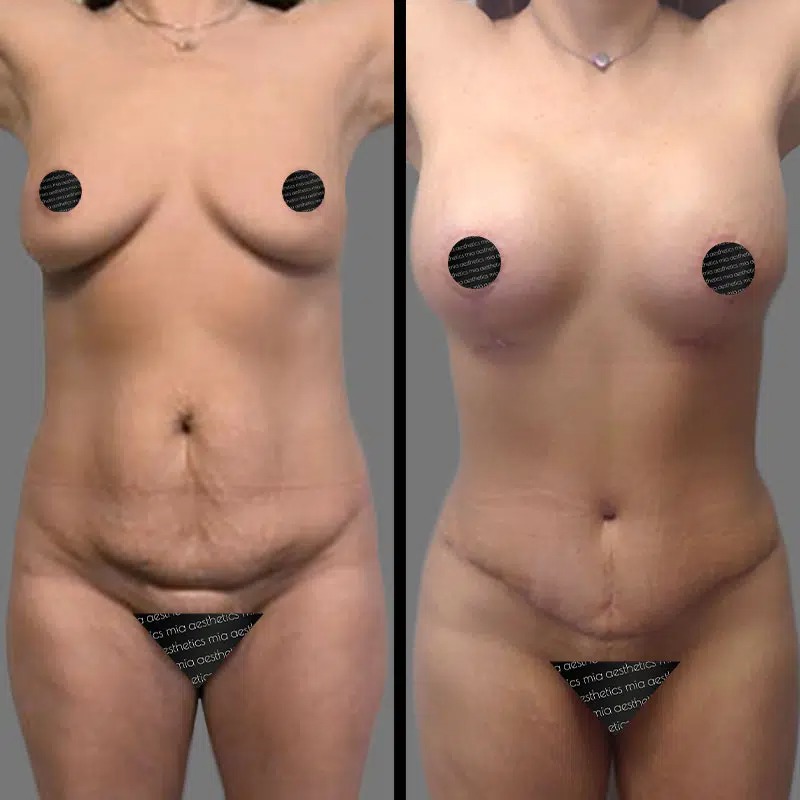 Dr. Patino • Mommy Makeover • image 2