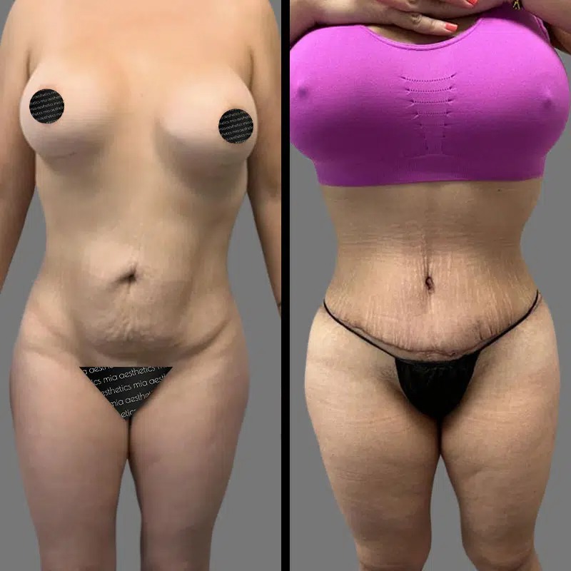 Dr. Patino • Tummy Tuck • image 1