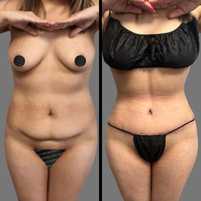 Dr. Patino • Tummy Tuck • image 3