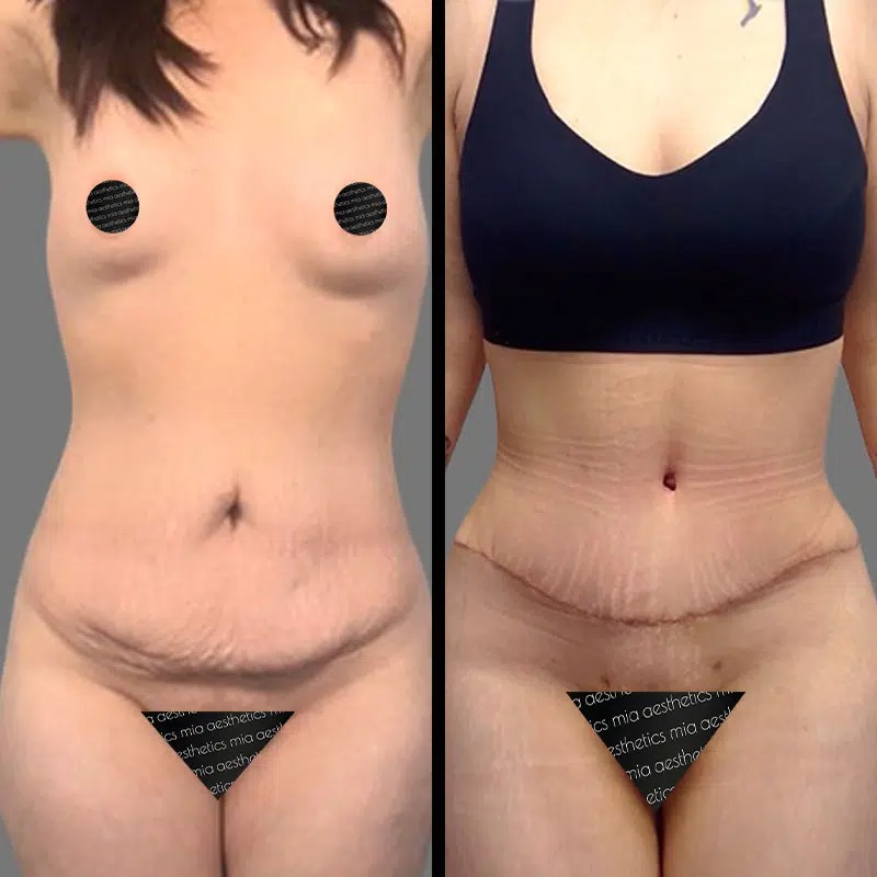 Dr. Patino • Tummy Tuck • image 5