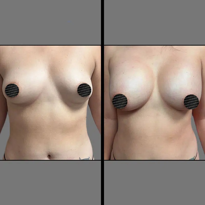 Dr. Rozentsvit • Breast Procedures • image 1