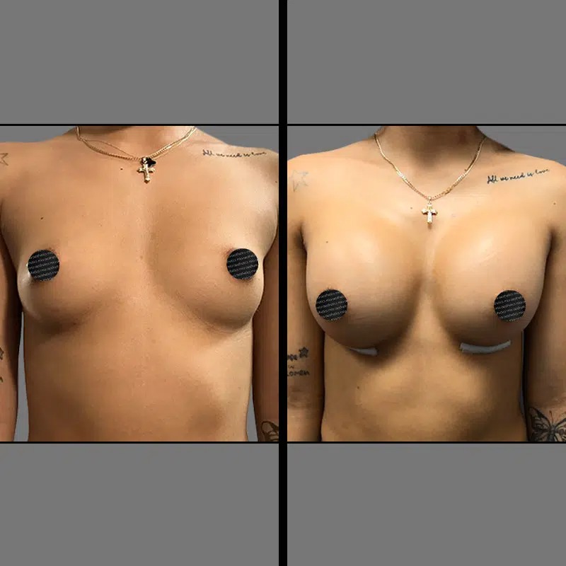 Dr. Rozentsvit • Breast Procedures • image 3
