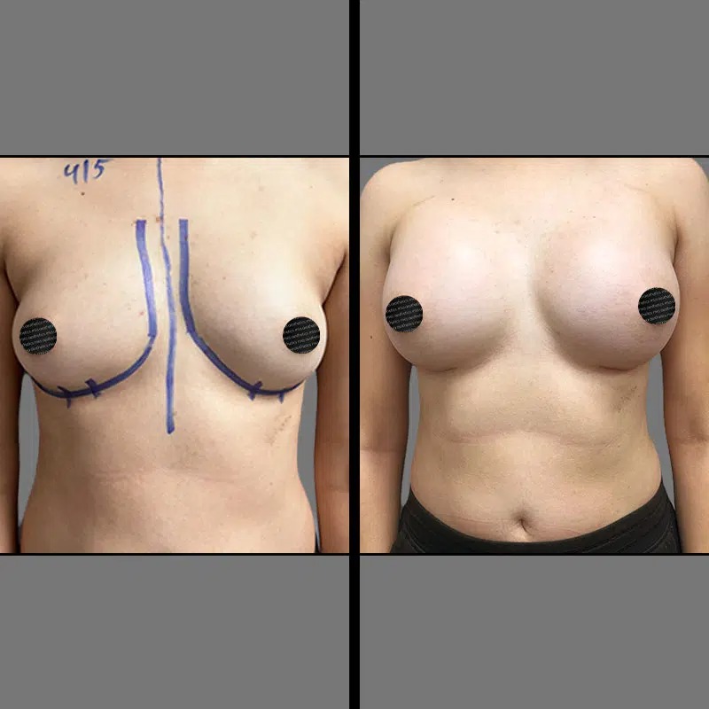 Dr. Rozentsvit • Breast Procedures • image 4