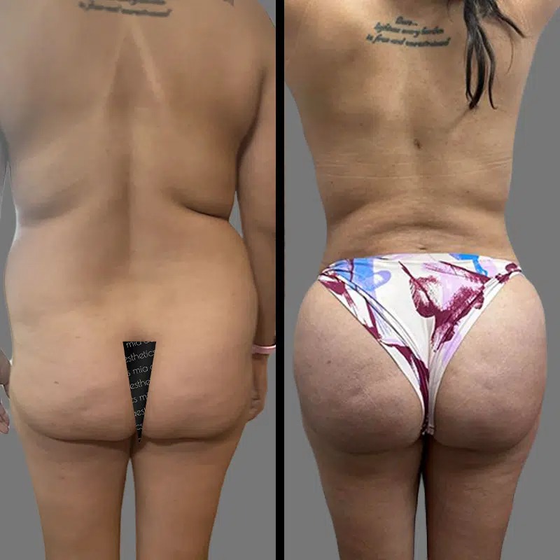 Dr. Rozentsvit • Brazilian Butt Lift (BBL) • image 1