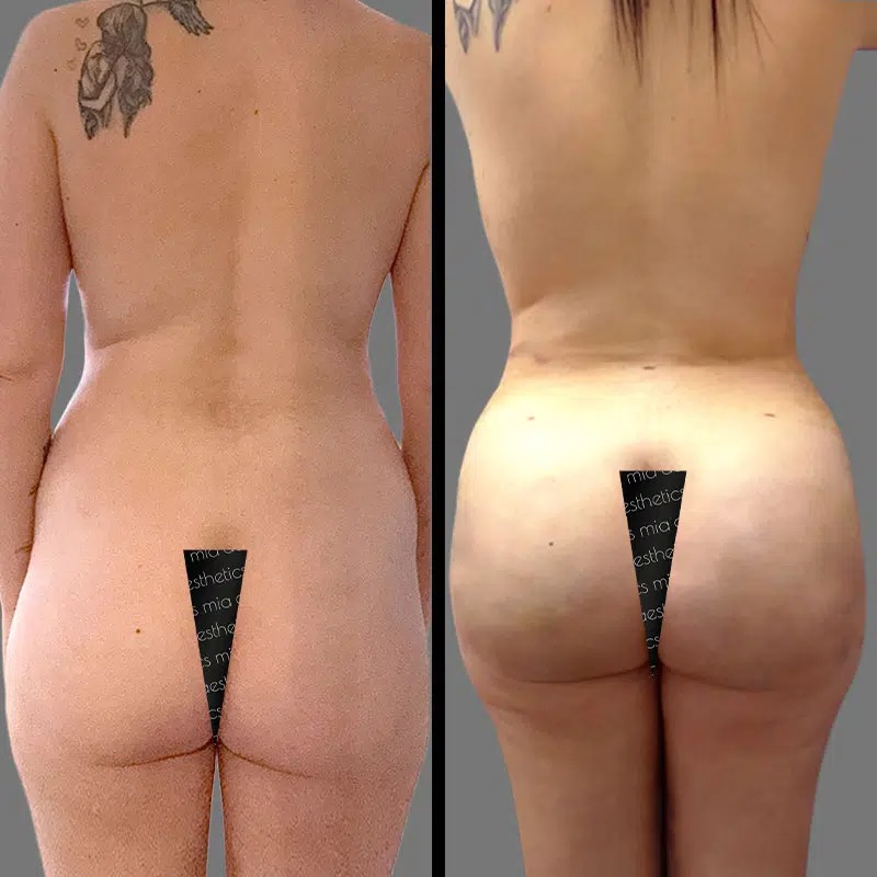 Dr. Rozentsvit • Brazilian Butt Lift (BBL) • image 2