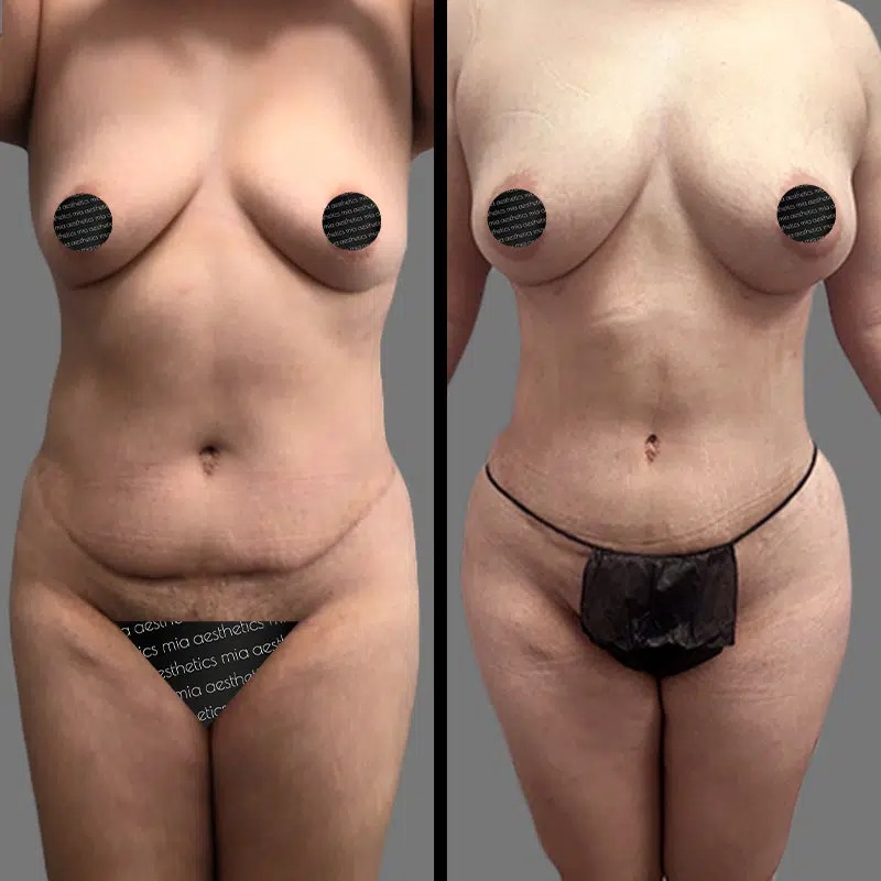 Dr. Rozentsvit • Lipo 360 • image 1