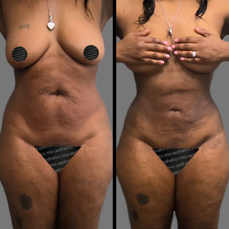 Dr. Rozentsvit • Lipo 360 • image 2