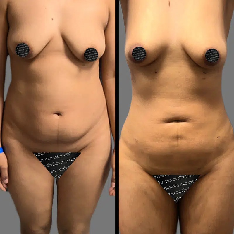 Dr. Rozentsvit • Lipo 360 • image 3