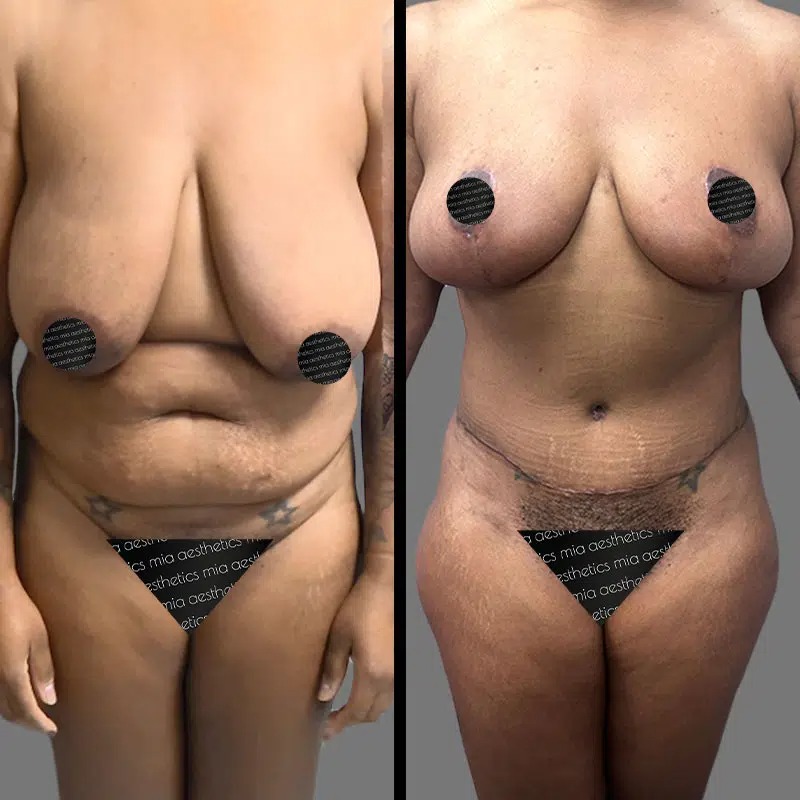Dr. Rozentsvit • Mommy Makeover • image 1