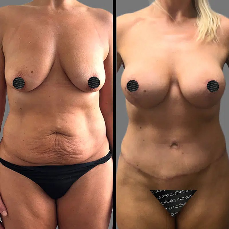 Dr. Rozentsvit • Mommy Makeover • image 2