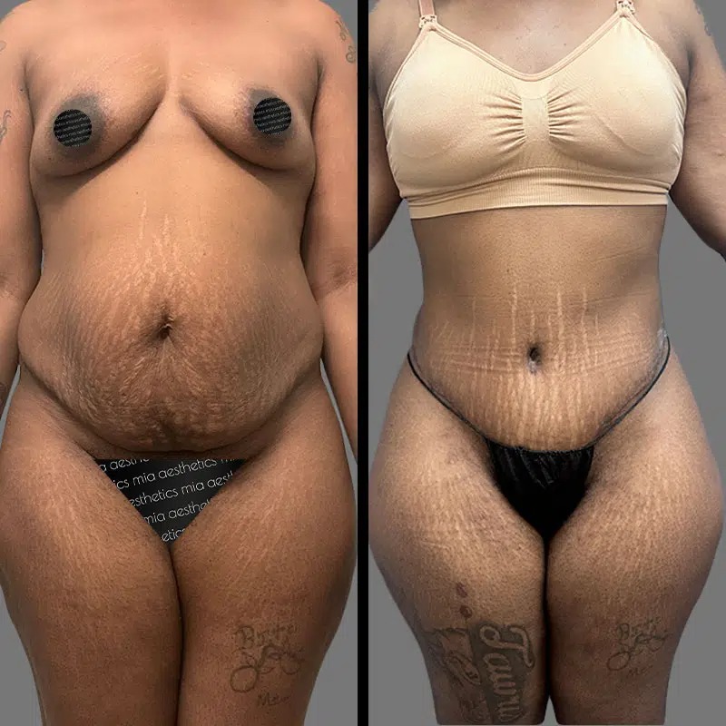 Dr. Rozentsvit • Tummy Tuck • image 2