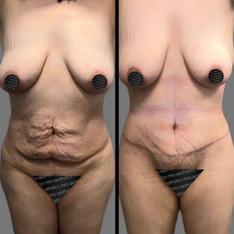 Dr. Rozentsvit • Tummy Tuck • image 3