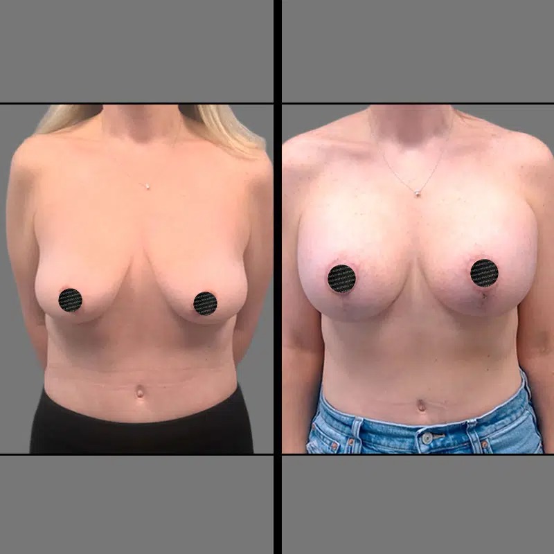 Dr. Sarcia • Breast Procedures • image 4