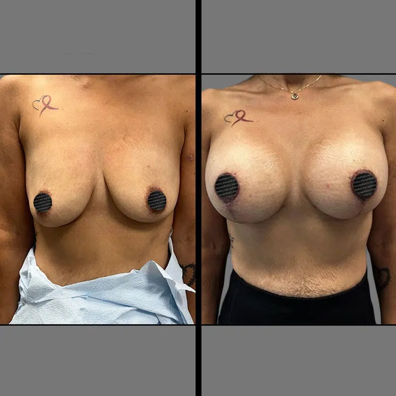 Dr. Sarcia • Breast Procedures • image 5