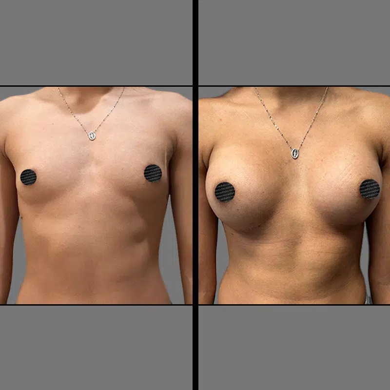 Dr. Sarcia • Breast Procedures • image 3
