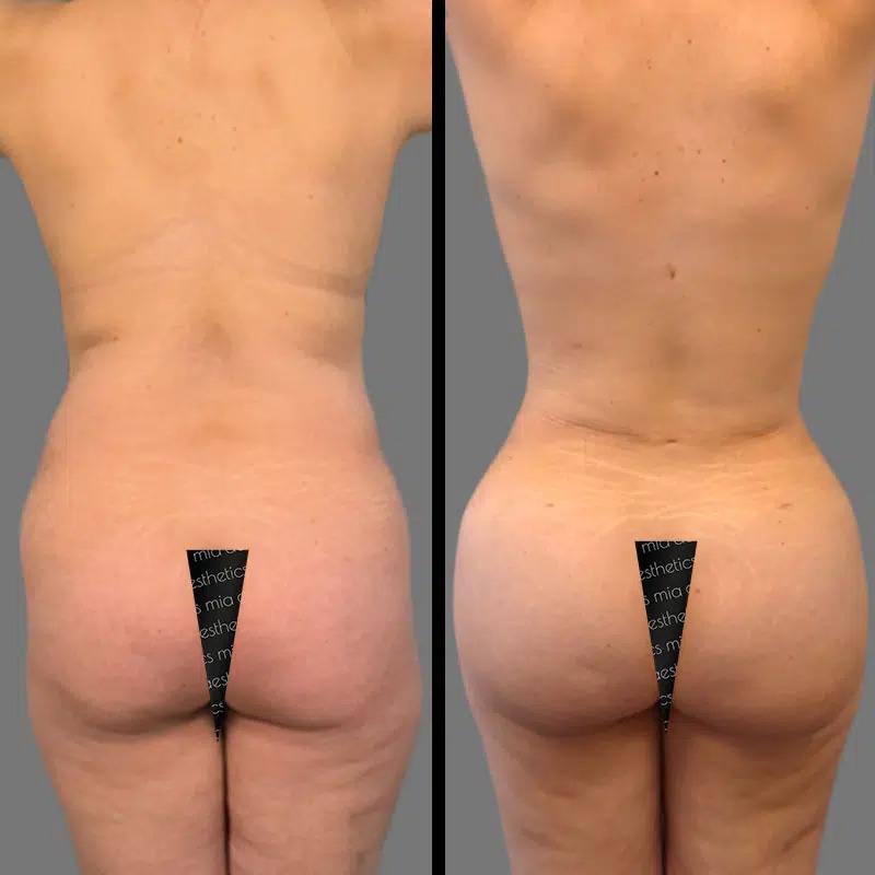 Dr. Sarcia • Brazilian Butt Lift (BBL) • image 3